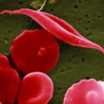 como-la-terapia-genica-curo-la-anemia-de-celulas-falciformes