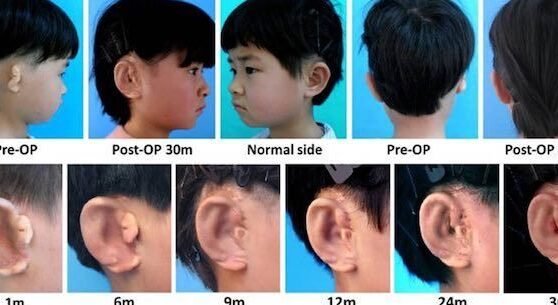 como-se-fabrican-orejas-humanas-con-impresoras-3d-y-celulas