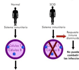 como-se-tratan-las-inmunodeficiencias-graves-con-genes