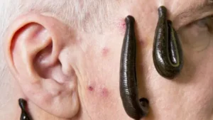 el-uso-de-la-saliva-de-sanguijuela-en-la-medicina-cardiovascular