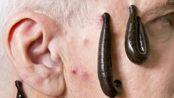 el-uso-de-la-saliva-de-sanguijuela-en-la-medicina-cardiovascular