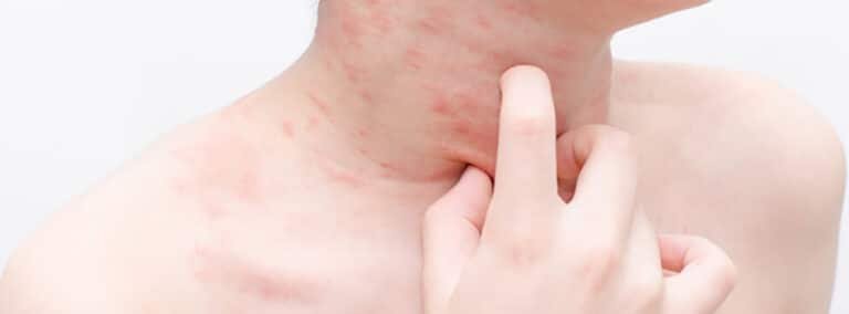 la-genetica-detras-de-las-alergias-graves-a-medicamentos