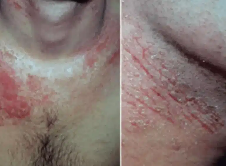 la-relacion-entre-genetica-y-efectos-adversos-cutaneos-graves