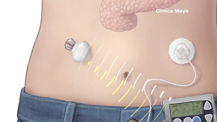 pancreas-artificial-la-esperanza-tecnologica-para-la-diabetes-tipo-1