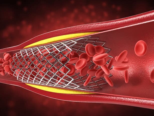 stents-bioabsorbibles-la-evolucion-de-la-cirugia-cardiaca