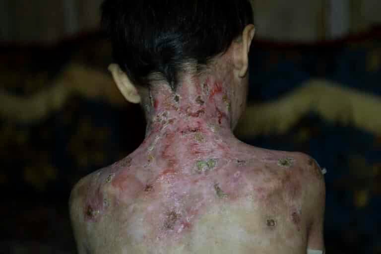 terapia-genica-para-la-piel-de-mariposa-epidermolisis-bullosa