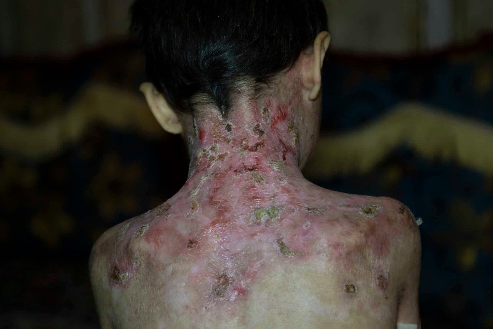 terapia-genica-para-la-piel-de-mariposa-epidermolisis-bullosa