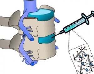 terapias-avanzadas-para-la-regeneracion-de-discos-intervertebrales