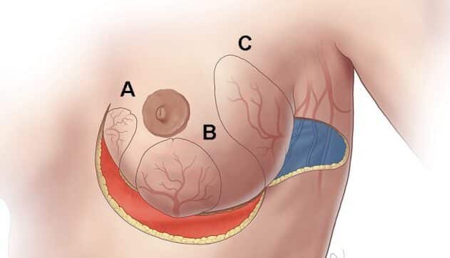 bioingenieria-de-tejido-adiposo-para-reconstruccion-mamaria