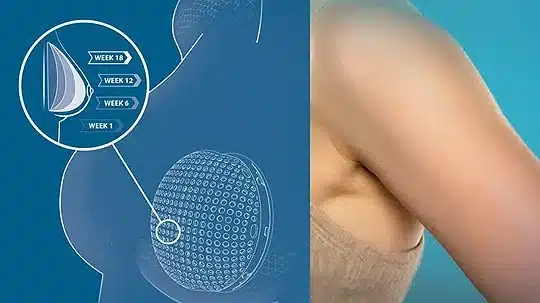 bioingenieria-de-tejido-adiposo-para-reconstruccion-mamaria