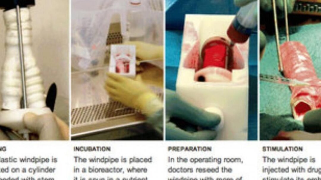 bioingenieria-de-traqueas-con-celulas-madre-del-propio-paciente