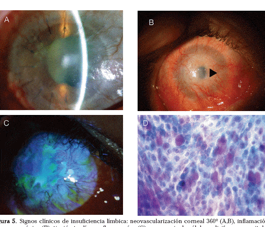 celulas-madre-limbares-para-restaurar-la-superficie-ocular