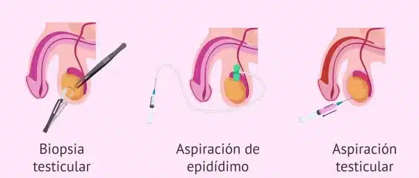 como-la-bioingenieria-aborda-la-infertilidad-masculina