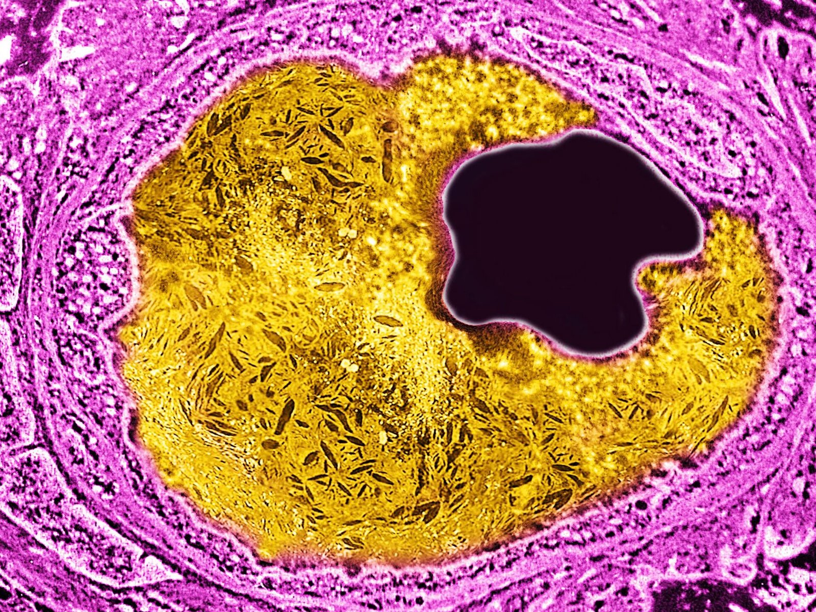 como-la-edicion-genetica-trata-el-colesterol-alto-hereditario