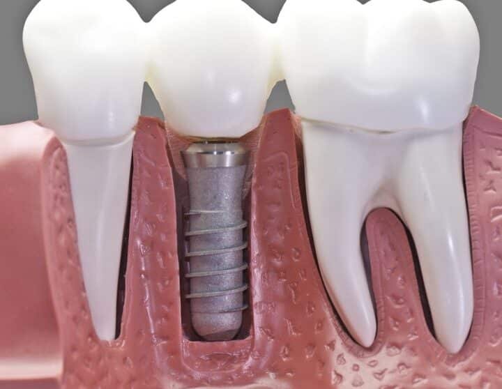 como-la-nanotecnologia-esta-mejorando-los-implantes-oseos