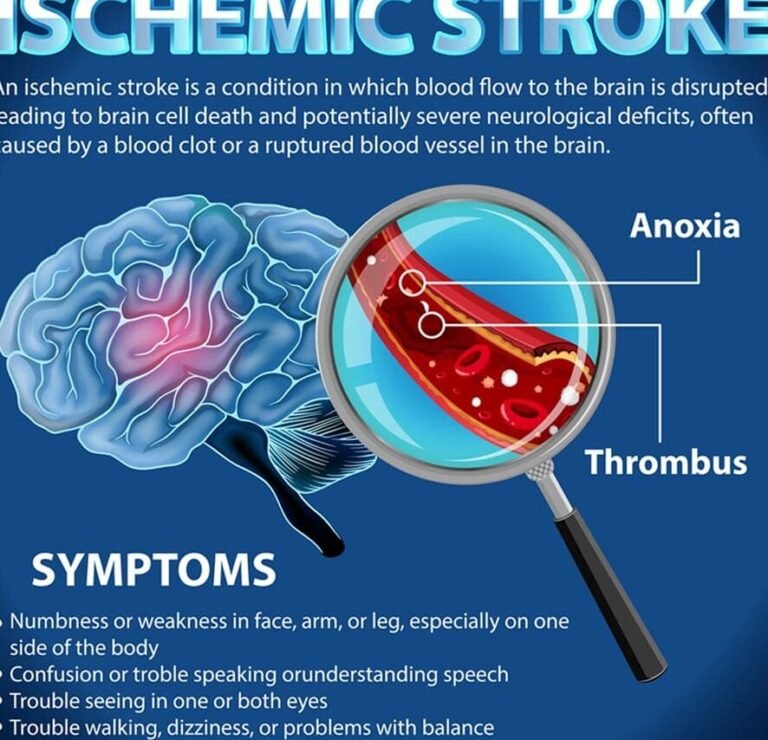 como-las-celulas-madre-neurales-tratan-el-ictus-isquemico