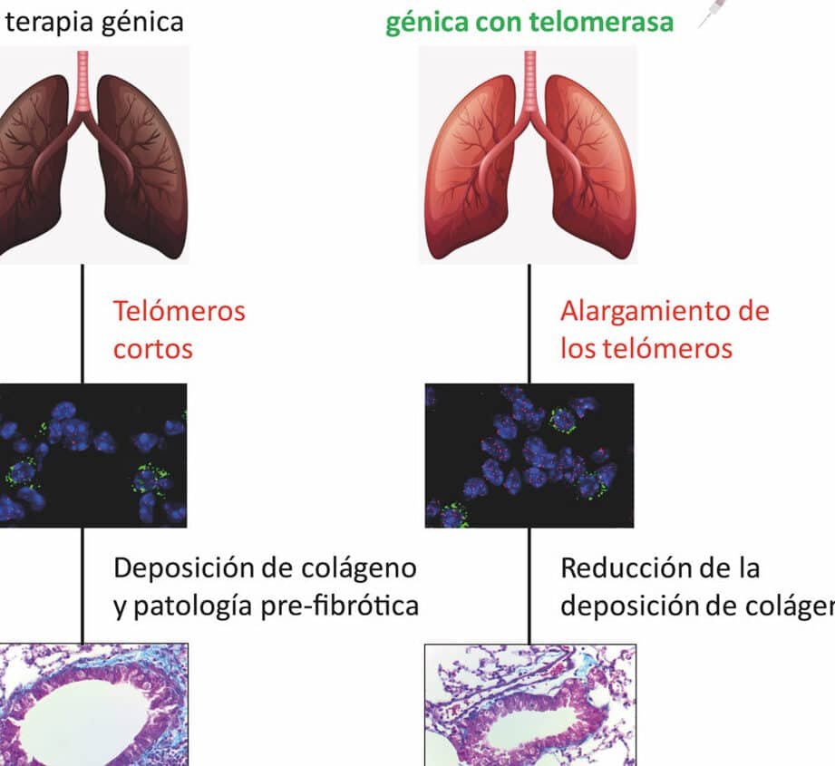 como-las-terapias-avanzadas-abordan-la-fibrosis-pulmonar