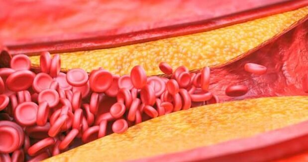 como-los-nanodiscos-eliminan-las-placas-de-ateroma