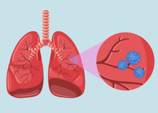 el-desarrollo-de-pulmones-artificiales-portatiles