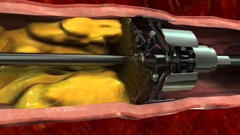 el-uso-de-nanorobots-para-desatascar-arterias-coronarias