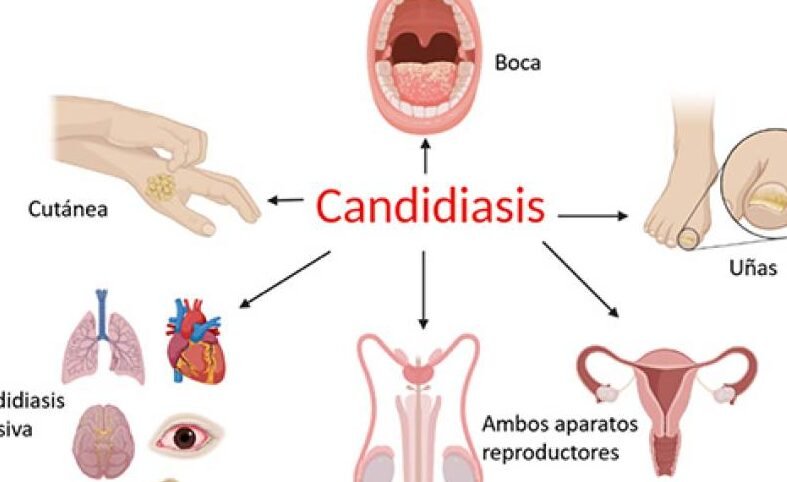 nanomedicina-para-el-tratamiento-de-infecciones-fungicas-sistemicas