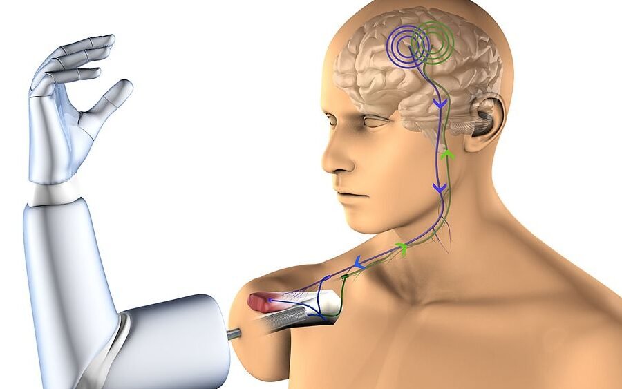 protesis-de-brazo-con-integracion-osea-directa