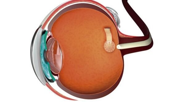 protesis-de-retina-para-devolver-la-vision-a-ciegos