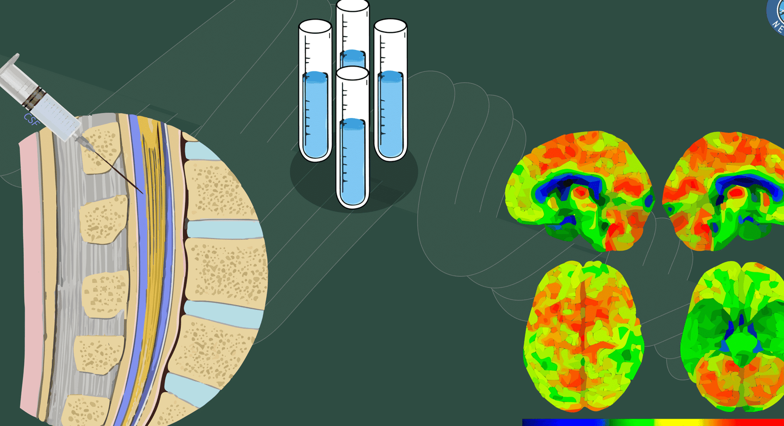 sensores-plasmonicos-para-la-deteccion-de-biomarcadores-de-alzheimer