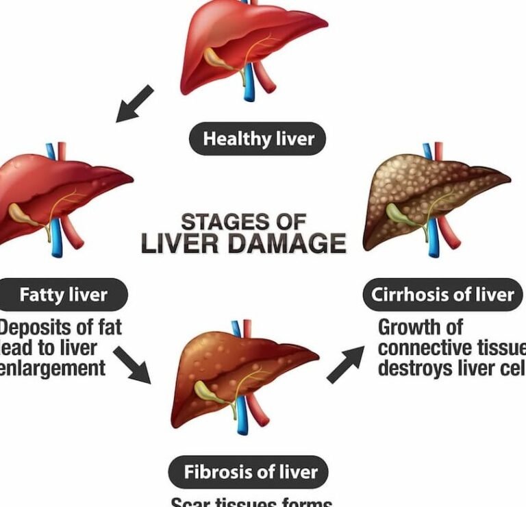 terapia-celular-para-la-cirrosis-hepatica