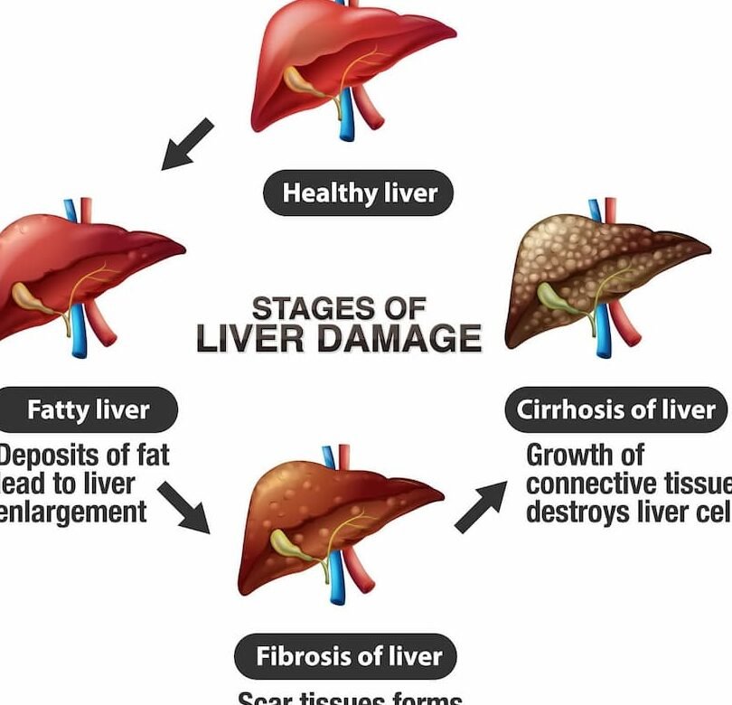 terapia-celular-para-la-cirrosis-hepatica