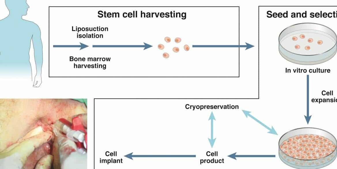 terapia-celular-para-la-enfermedad-de-crohn-y-fistulas