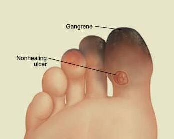 terapia-celular-para-la-isquemia-critica-de-miembros