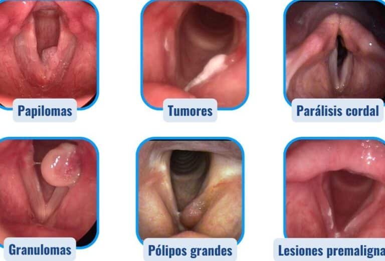 terapia-celular-para-la-regeneracion-de-las-cuerdas-vocales