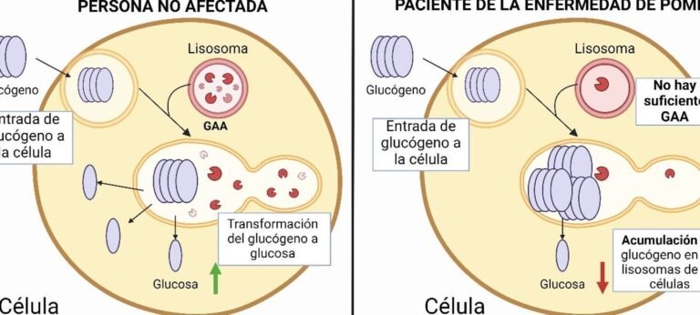 terapia-genica-para-la-enfermedad-de-pompe