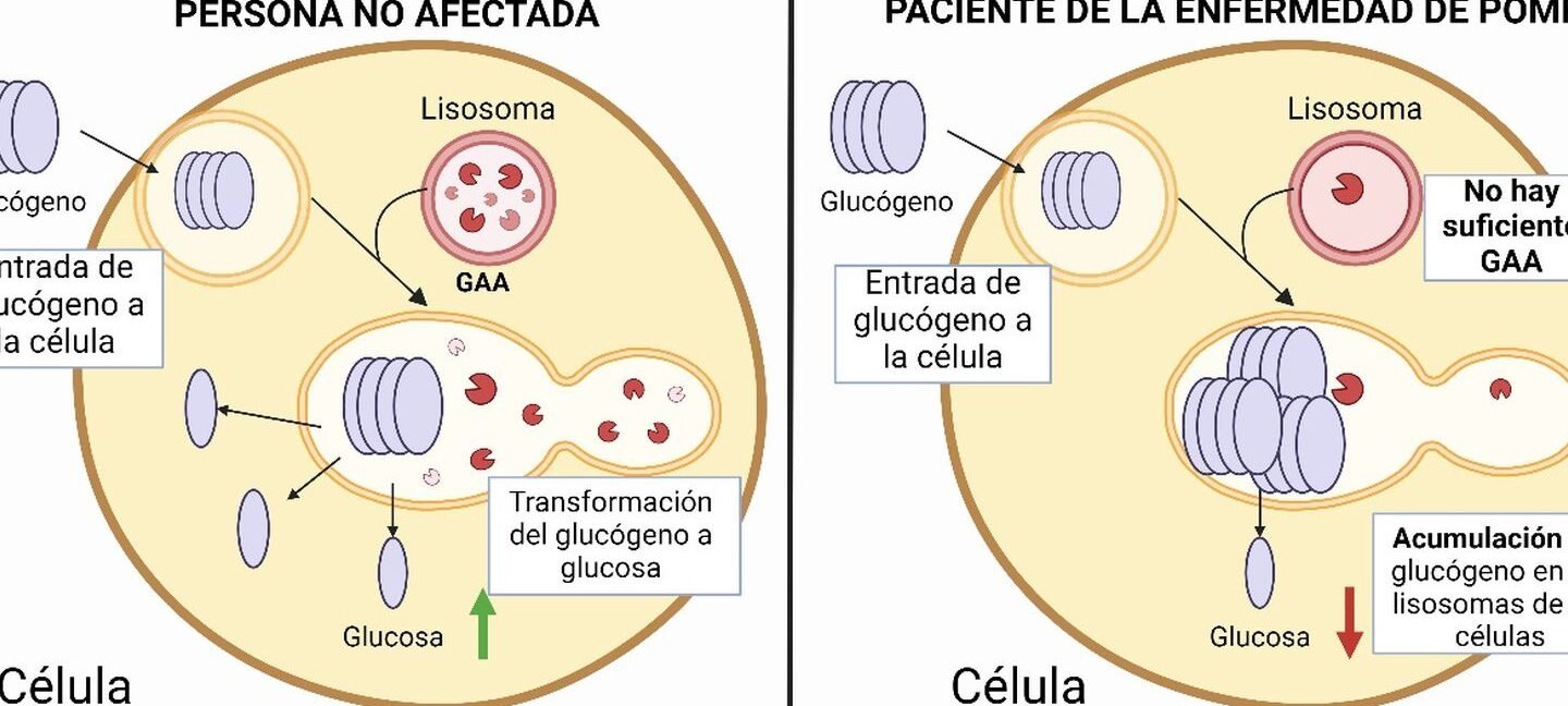 terapia-genica-para-la-enfermedad-de-pompe