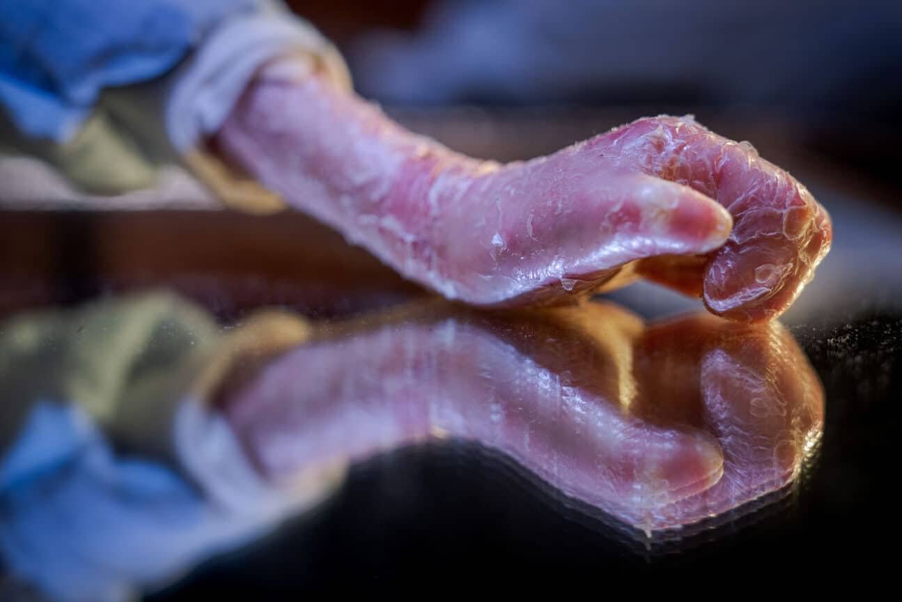 terapias-avanzadas-para-la-epidermolisis-bullosa-piel-de-mariposa