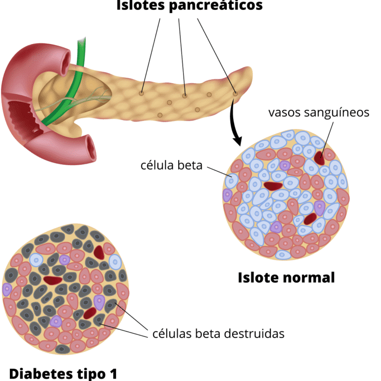 trasplante-de-islotes-pancreaticos-encapsulados-para-diabetes