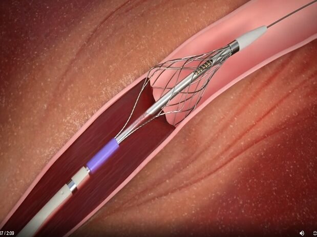 como-la-nanotecnologia-ayuda-a-disolver-coagulos-sanguineos-trombosis