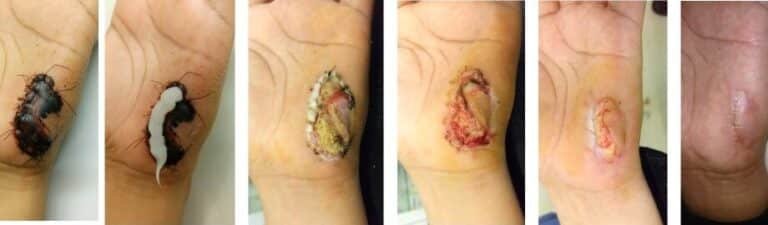 como-las-enzimas-de-la-papaya-ayudan-en-el-desbridamiento-de-heridas