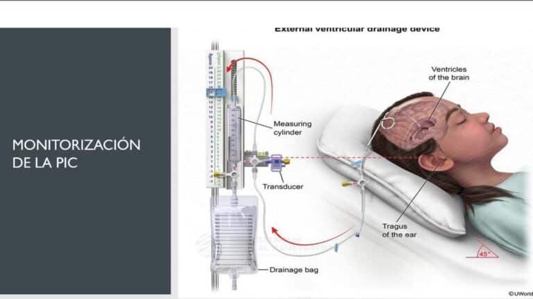 como-los-nanosensores-implantables-monitorean-la-presion-intracraneal