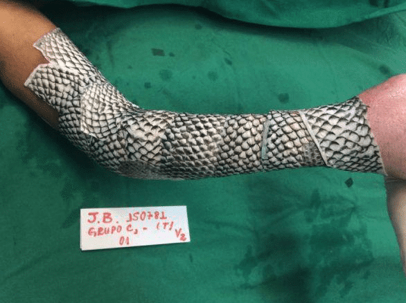 el-uso-de-la-piel-de-tilapia-para-curar-quemaduras-graves