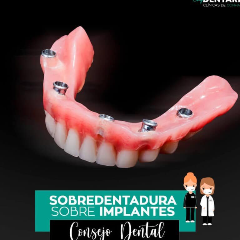 nanocubiertas-para-implantes-dentales-que-previenen-infecciones