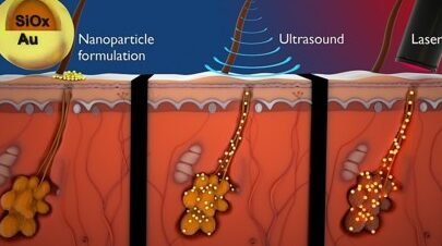 nanoparticulas-para-el-tratamiento-del-acne-severo