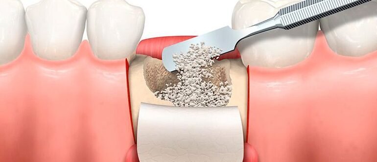 uso-de-la-estructura-del-hueso-de-sepia-para-injertos-oseos